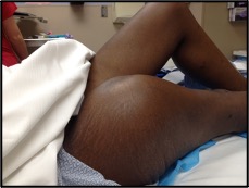 Figure 1: Right thigh swelling